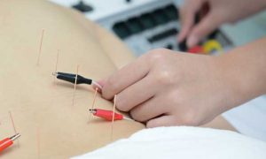 Electro-acupuncture - Acupuncture Medicine South Melbourne